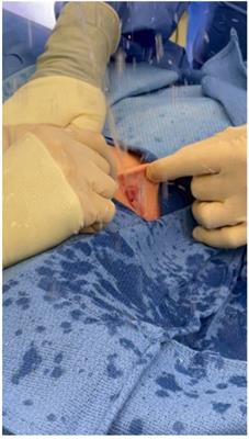 Anterior deflected urinary stream in female children: description of a unique clinical entity and surgical management